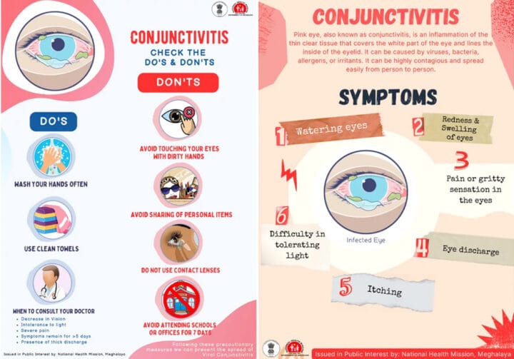 Conjunctivitis