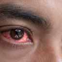 Conjunctivitis