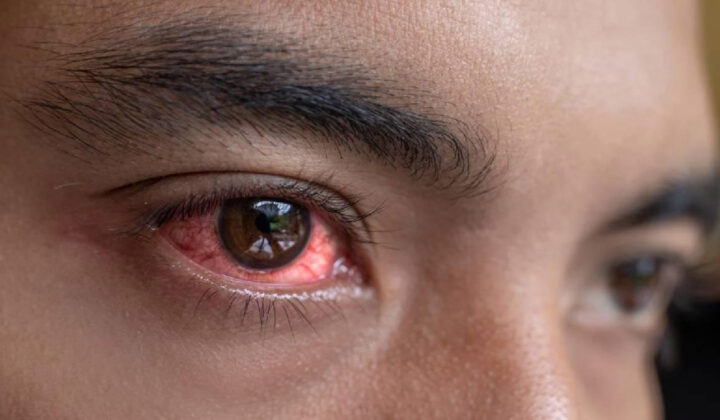 Conjunctivitis